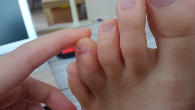 足の指骨折