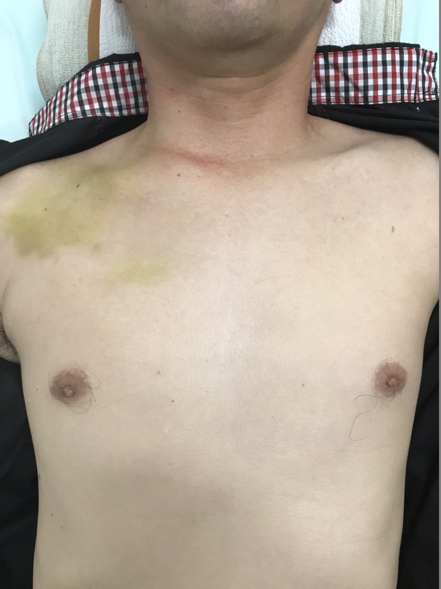 右鎖骨骨折